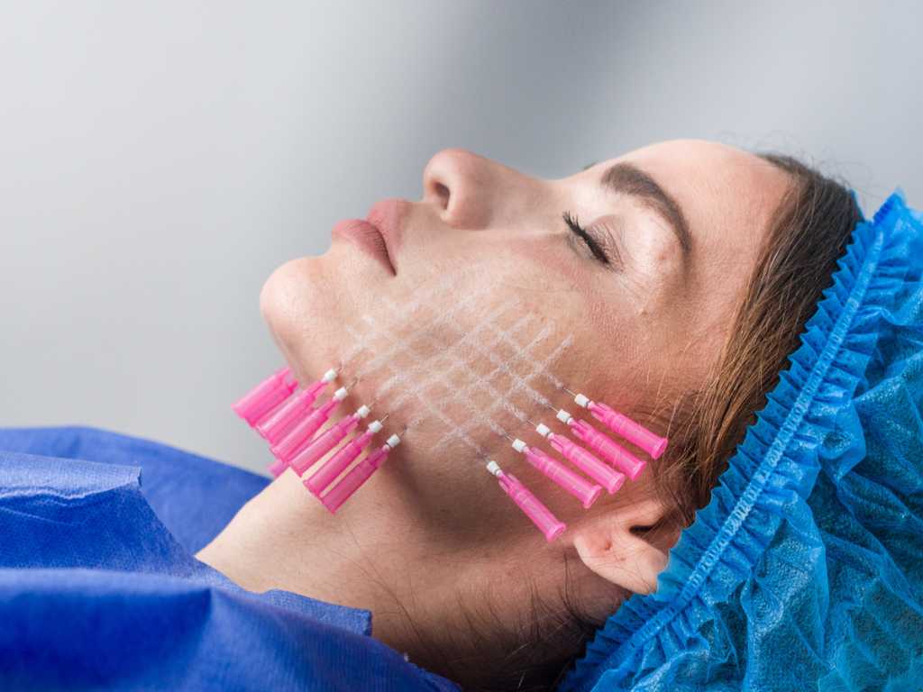 La revolución del lifting no quirúrgico: Hilos tensores y sus&nbsp;beneficios.